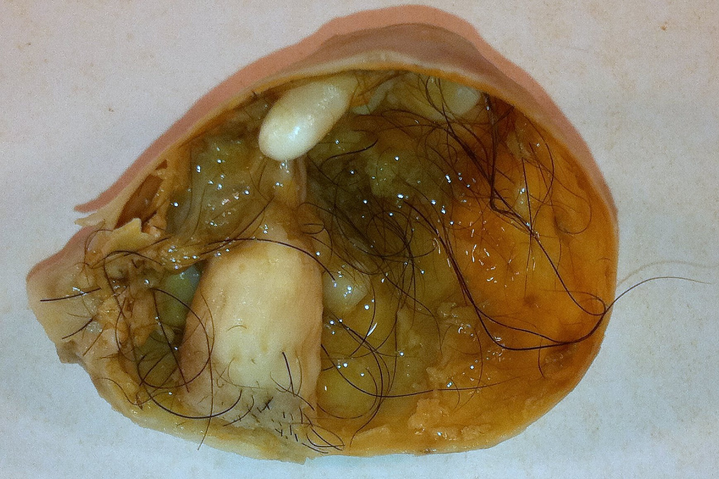 Ed Uthman, Mature Cystic Teratoma of the Ovary, 2011.